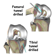femoral tunnel drilled,acl injury,acl reconstruction india,acl reconstruction best india,acl reconstructionbest doctors in india,acl reconstruction best surgeon in india,acl reconstructionbest surgery in india,acl reconstruction best treatment in  india,acl reconstruction in south  india,acl reconstruction north  india,acl reconstruction  east india,acl reconstruction west india,acl reconstruction best in  india,acl reconstruction best surgery in india,acl reconstruction cost-effective in  india,acl reconstruction best doctors in india,acl reconstruction india,acl reconstruction india,acl reconstruction india,acl reconstruction now in india,acl reconstruction india,acl reconstruction by dr.bajaj,acl reconstruction by p.s.bajaj
